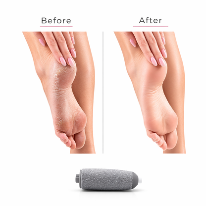 Shoparivo™ Electric Callus Remover